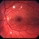 HIV Retinopathy